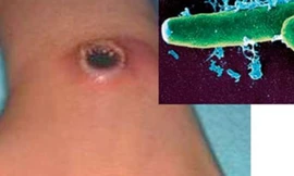 Ăn thịt gia súc chết, 9 người mắc phải bệnh than