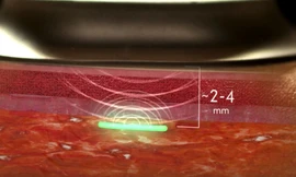 Cảm biến được làm bằng vật liệu tổng hợp hydrogel mềm mỏng tương tự như kính áp tròng