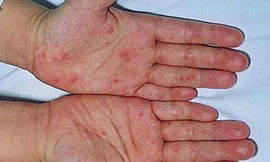 Cứu sống bệnh nhi tay chân miệng thể nặng nhất