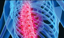 Những thói quen xấu gây bệnh loãng xương