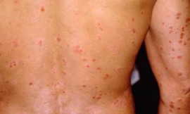 Vẩy nến trên lưng và tay