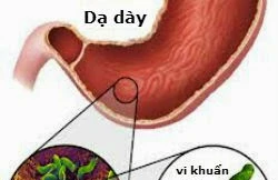 Tai biến là nguyên nhân gây tàn phế và mất trí nhớ ở nhiều người trưởng thành. (Ảnh minh hoạ: IE)