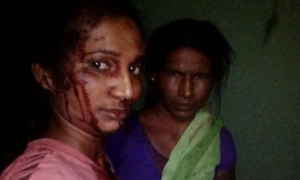 Meshram mặt đầy máu khi vào viện cấp cứu vì đánh nhau với hổ. Ảnh: BBC.