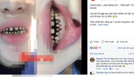  Chị T.N chia sẻ về tình trạng răng sau 2 năm bọc răng sứ.