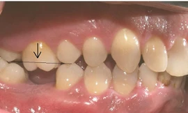 Mất răng cấm cần được trồng lại răng giả sớm