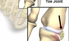 Nồng độ axit uric trong máu cao – Có phải mắc gút?