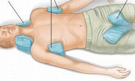 Đặt túi chườm đá ở nách, bẹn giúp làm giảm nhiệt độ ở người bị sốc nhiệt do nắng nóng