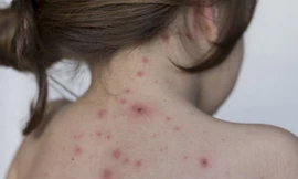 Thủy đậu vốn lành tình nhưng nếu không phát hiện kịp thời và điều trị đúng cách có thể gây ra nhiều biến chứng nguy hiểm khó lường