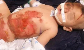 Bệnh nhi bỏng nặng sau khi bị bình nước sôi đổ lên người