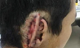 Ðiều tra vụ nghi vấn 'phê cỏ Mỹ' cắn đứt tai bạn