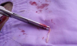 Mê ăn gỏi cá sống, một phụ nữ có sán... ở đùi