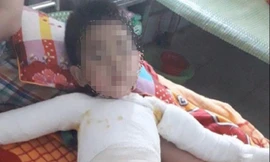 Ghép da 3 lần, bệnh nhi 5 tuổi bị bỏng nặng toàn thân được cứu sống