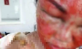 Chị Ng. bị bỏng nặng đang được điều trị tại bệnh viện