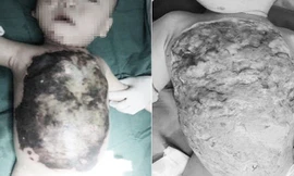 Đắp thuốc chữa bỏng của thầy lang, bé trai 13 tháng tuổi bị hoại tử da