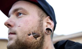 Miếng thủy tinh găm trong má 17 ngày không biết