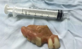 Hàm răng giả được các bác sỹ gắp ra khỏi thực quản ông Ng