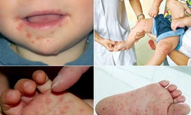 Vắc-xin phòng bệnh tay chân miệng: Có hay chưa?