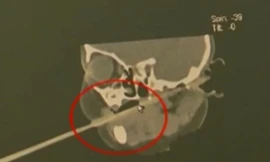 Phim chụp hình ảnh đũa kẹt trong họng bé 1 tuổi.