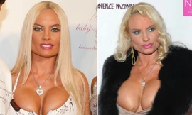 Những bộ ngực biến dạng vì dao kéo hỏng của sao ngoại