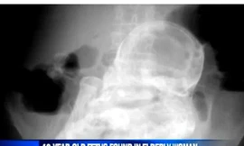 Bào thai vôi hóa 40 năm được tìm thấy trong bụng cụ bà
