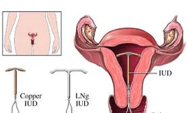 Dụng cụ tránh thai trong tử cung làm giảm nguy cơ ung thư