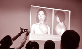 Khuôn mặt mới được cấy lên phía ngực trái của cô gái 17 tuổi Xu Jianmei