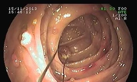 Nội soi cắt gần 40 u lành ở ruột già