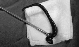 Con vắt nằm trong khí quản ông A Bói được bác sĩ gắp ra