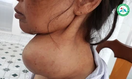 Bà Y V. với khối u đeo nặng trên cổ trước khi mổ