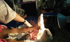 Hai cẳng chân của nạn nhân được các bác sĩ phẫu thuật ghép nối thành công