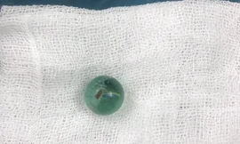 Viên bi kích thước 1,5cm được lấy ra từ cổ họng cháu H - Ảnh: ĐK