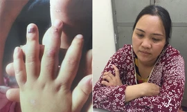 Bà Hải (bìa phải) đã hành hạ con gái người tình; trong đó đánh làm các ngón tay trẻ bầm dập (bìa trái). *ảnh: Nguyệt My