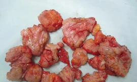 Nam nhi suýt chết vì bơm ngực, độn mông