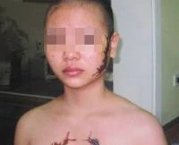 Nạn nhân Giang với 3 hình xăm “quái thú”.