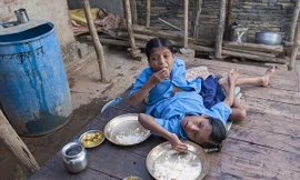 Cuộc sống của cặp song sinh dính liền nhau 