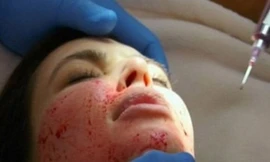  Thủ thuật làm đẹp bằng máu người này sẽ giúp kéo dài tuổi thanh xuân.