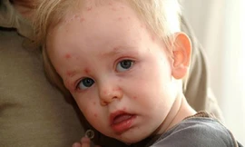 Thời tiết nắng nóng khiến trẻ bị rôm sảy.