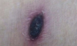 Vết đốt do côn trùng gây nên. Ảnh H.Hải