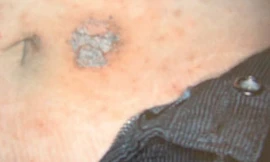 Viêm da tiếp xúc là bệnh gì?