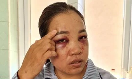 Chị Hằng với khuôn mặt bầm tím đang điệu trị tại bệnh viện