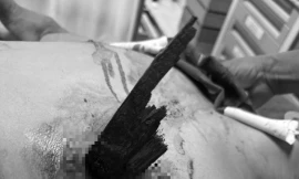 Chạy xe máy mất lái đâm vào hàng rào, nam thanh niên bị thanh gỗ đâm thấu ngực 
