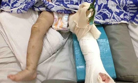Bé gái bị mẹ nuôi đánh gãy chân. Ảnh: Quế Biên.