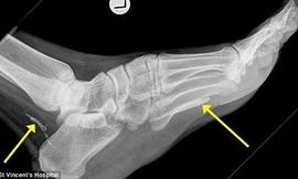 Ảnh chụp X quang cho thấy những phần còn lại của con giun