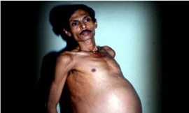 Kỳ lạ, người đàn ông mang thai suốt 36 năm