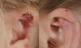 Mất một phần tai vì bị nhện cắn