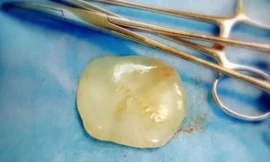 "Viên ngọc" rơi ra từ bụng sản phụ trong quá trình mổ đẻ ở Trung Quốc.