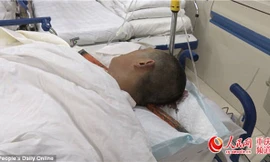 Anh Wang Long bị thanh thép lớn đâm xuyên qua đầu trong một vụ tai nạn lao động.