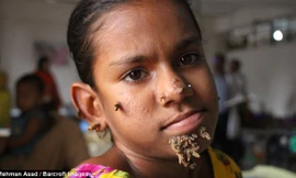 Các bác sỹ tại Bệnh viện Đại học Y Dhaka nghi ngờ Khatun mắc "hội chứng người cây".