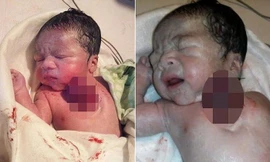 Bé gái sinh ra có trái tim nằm ngoài lồng ngực