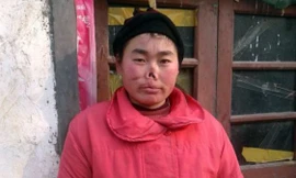 Cô gái bị chuột cắn đứt... mũi